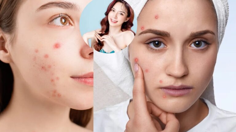 Pimples skin care at home